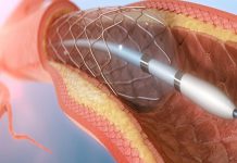 آنژیوگرافی