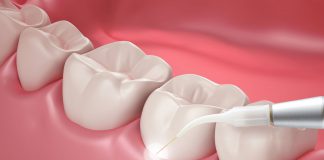 کاربرد لیزر در دندان پرشکی