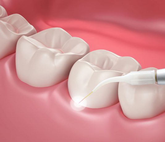 کاربرد لیزر در دندان پرشکی