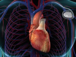 انواع پیس میکر