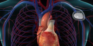 انواع پیس میکر