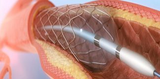 آنژیوگرافی