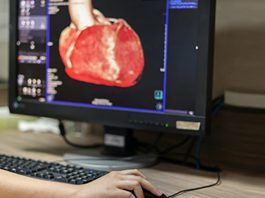 سی تی آنژيوگرافی