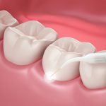 کاربرد لیزر در دندان پرشکی